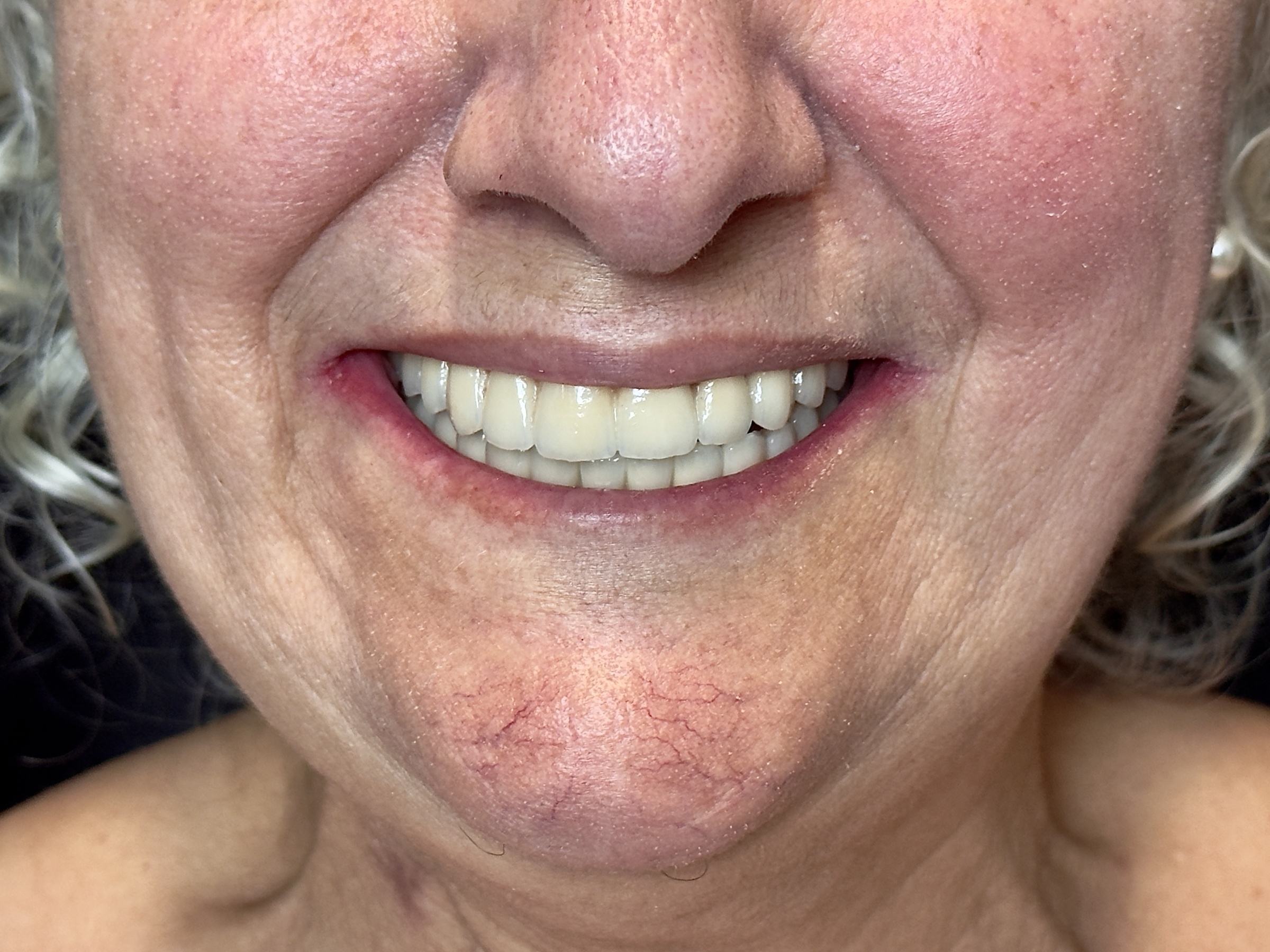 Fotografia final dos dentes após a aplicação das facetas