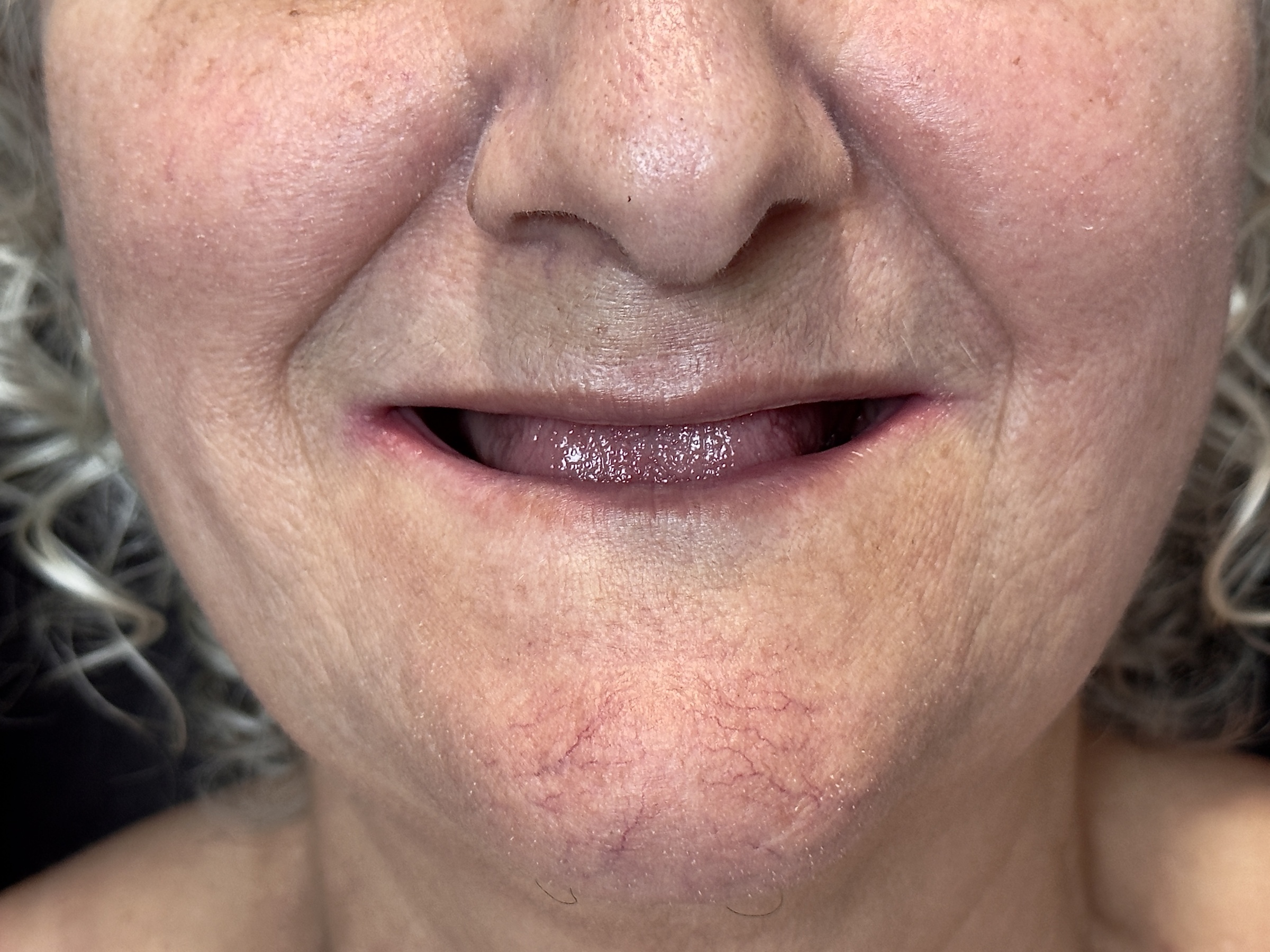 Fotografia inicial dos dentes antes da reabilitação estética