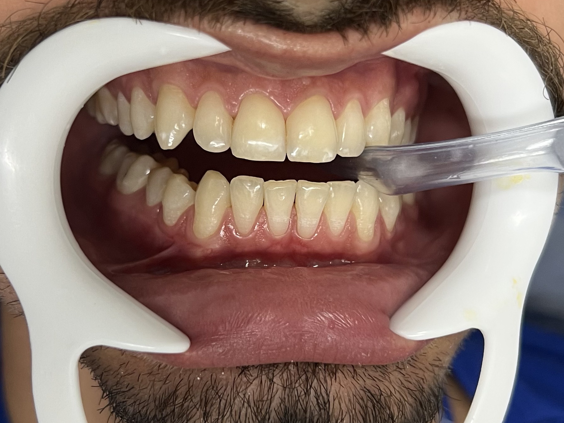 Fotografia inicial dos dentes antes do clareamento dental