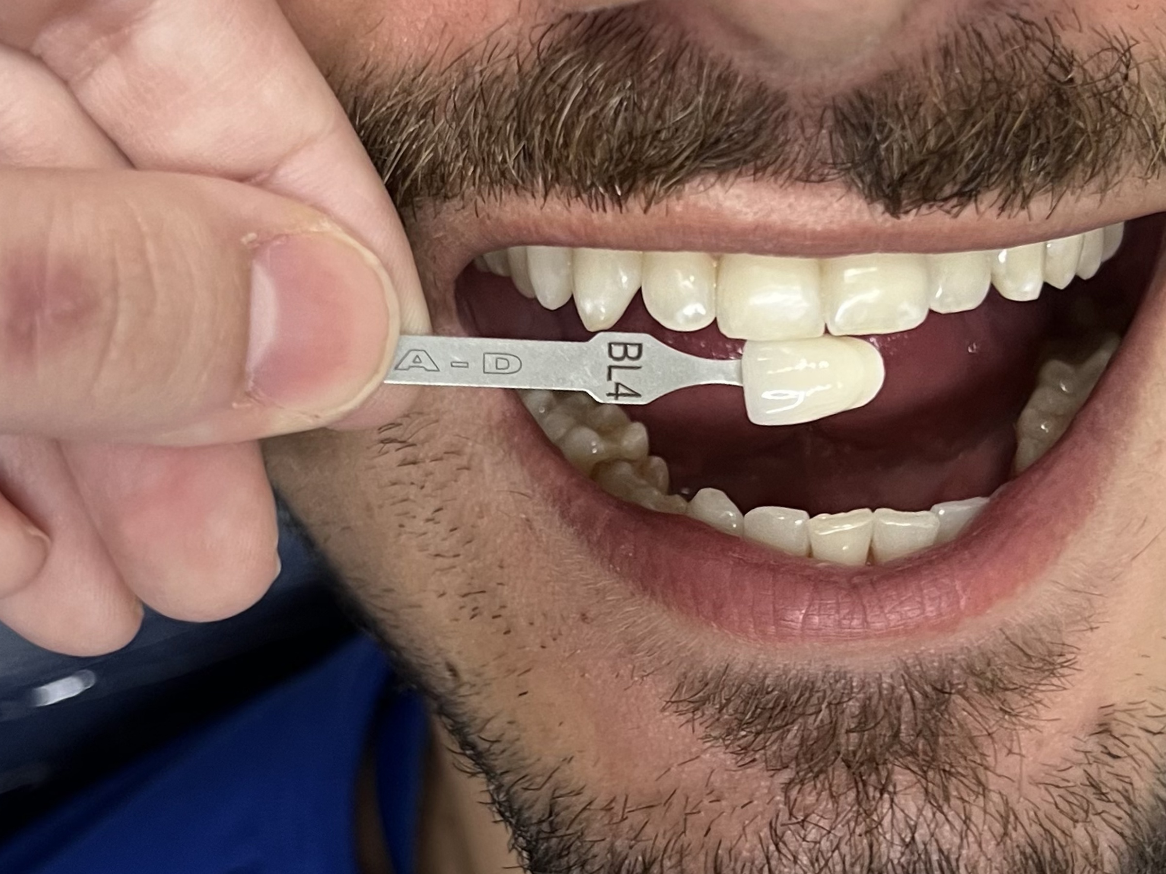 Fotografia final dos dentes após o clareamento dental completo