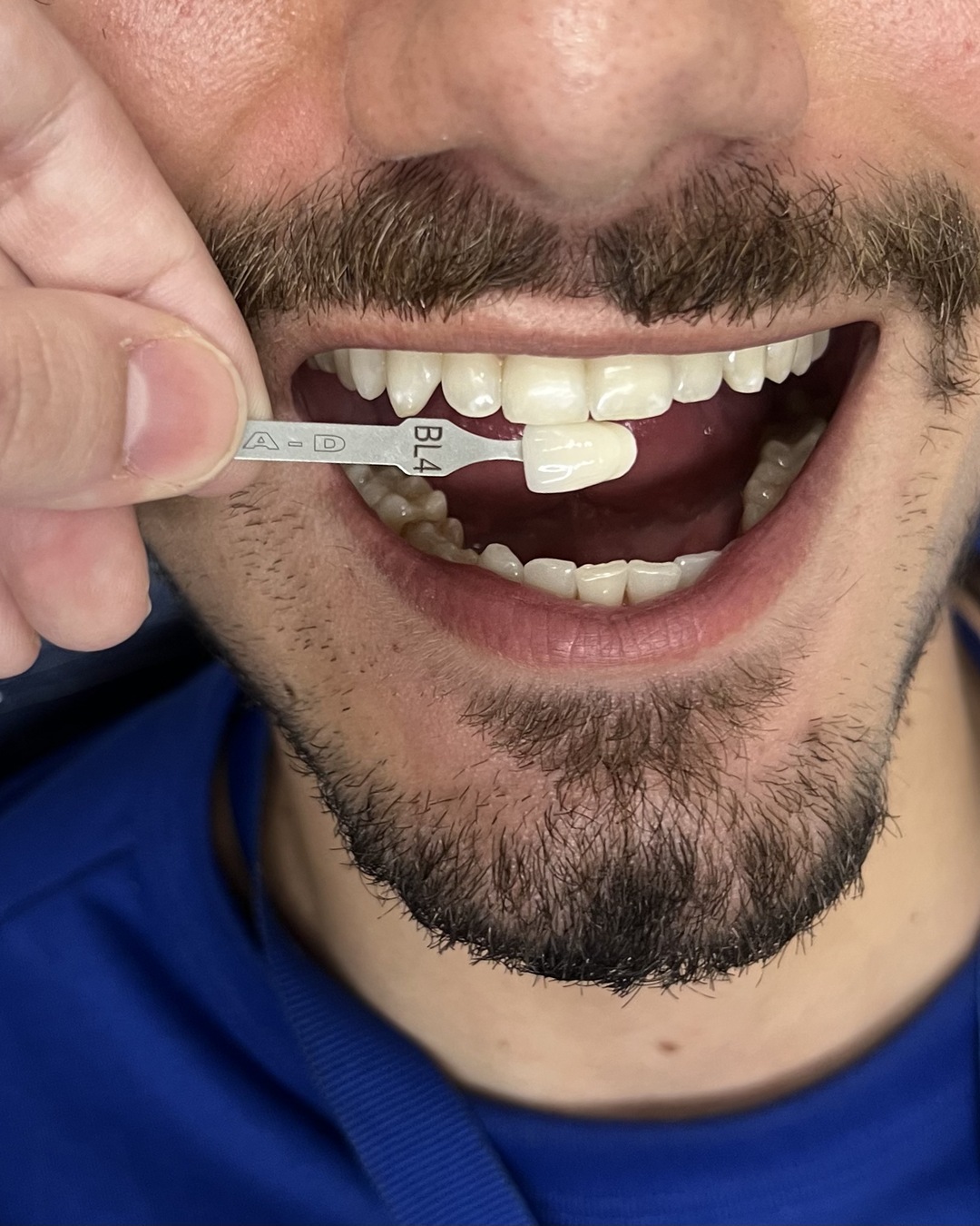 Caso Clínico Real — Clareamento Dental Supervisionado com Dra. Ane Salomão