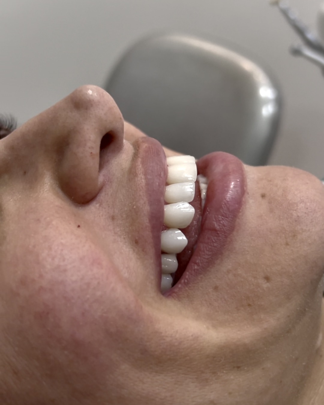 Caso Clínico Real — Facetas Cerâmicas e Laminados com Dra. Ane Salomão